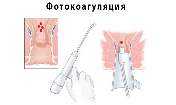 Фотокоагуляция, связанная с применением инфракрасных волн, которые своим прямым направленным воздействием на ножку узла приводят к его отмиранию