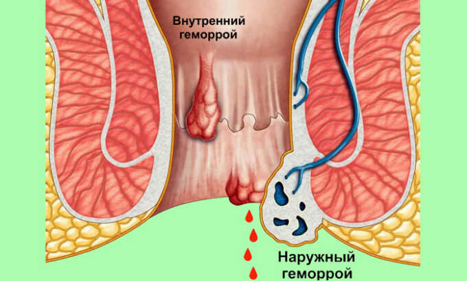Обильное кровотечение является осложнением при геморрое
