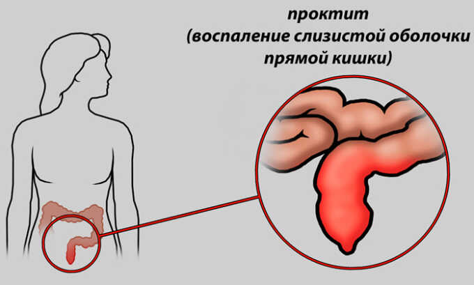 Ирригоскопию нельзя делать людям у которых идёт острый воспалительный процесс в кишечнике