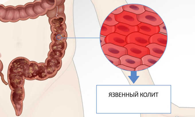 Колит является осложнением геморроя
