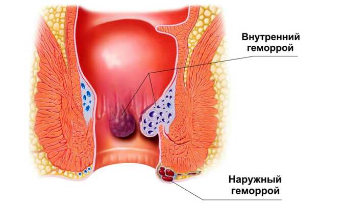 Геморрой может быть внутренним и наружным