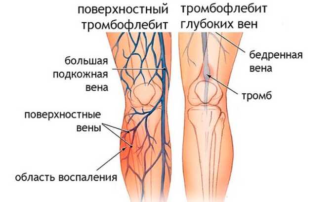 Использование чеснока запрещено для людей, страдающих от тромбофлебита