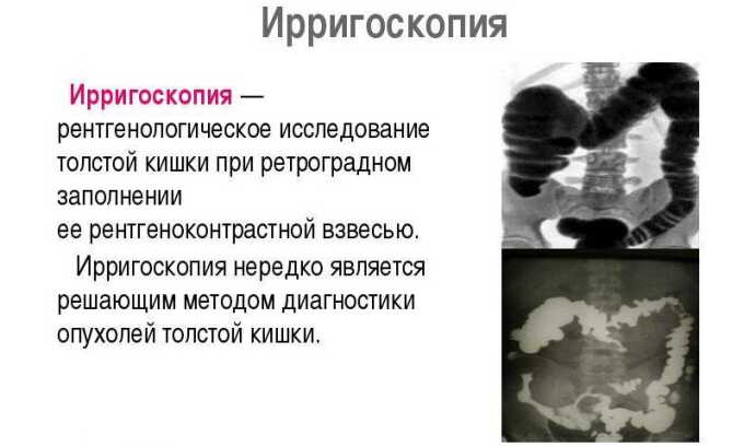Ирригоскопия позволяют выявить другие заболевая кишечника, сопровождающиеся кровотечением