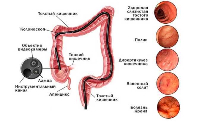 Колоноскопия обеспечивает возможность получения показателей, которые до недавнего времени были результатом длительных исследований