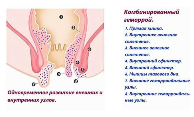 При комбинированном геморрое патологическим изменениям подвергаются сосуды анальных тканей и прямой кишки