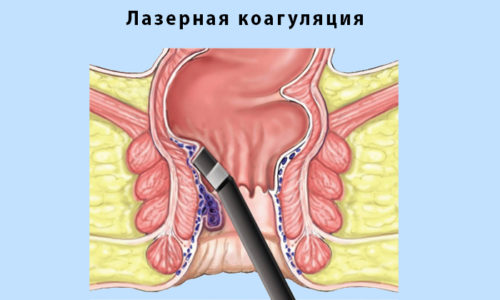 Как проводится удаление геморроя лазером?
